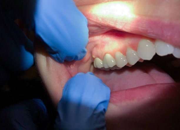 Best Emergency Dentist for Lost Fillings or Crowns in Graham, TX